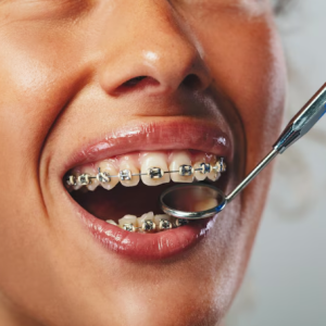 Discovering the Perfect Fit: A Comprehensive Guide to Types of Braces at Smile Art