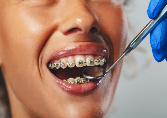 Discovering the Perfect Fit: A Comprehensive Guide to Types of Braces at Smile Art