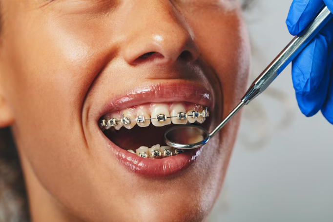 Discovering the Perfect Fit: A Comprehensive Guide to Types of Braces at Smile Art