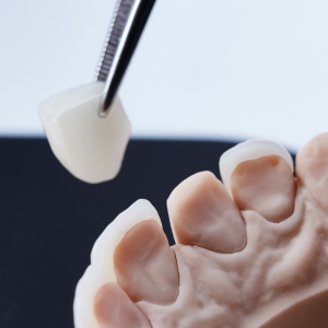 Dental Veneers