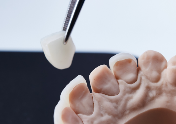 Dental Veneers