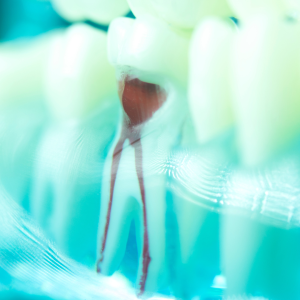 Root Canal