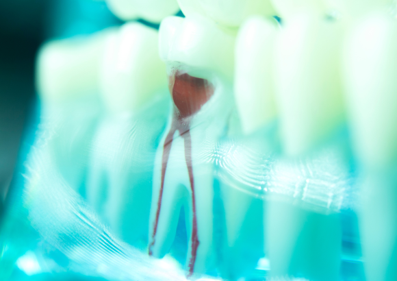 Root Canal