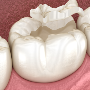 Tooth Coloured Fillings