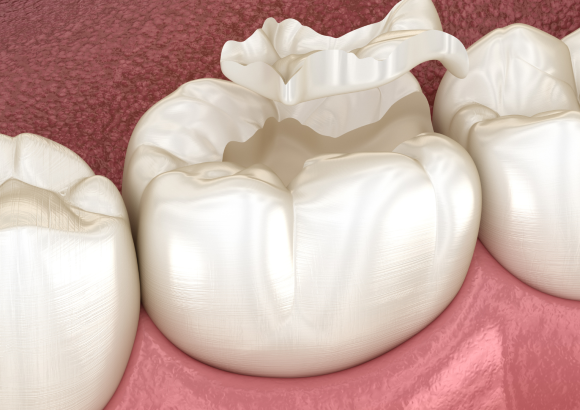 Tooth Coloured Fillings