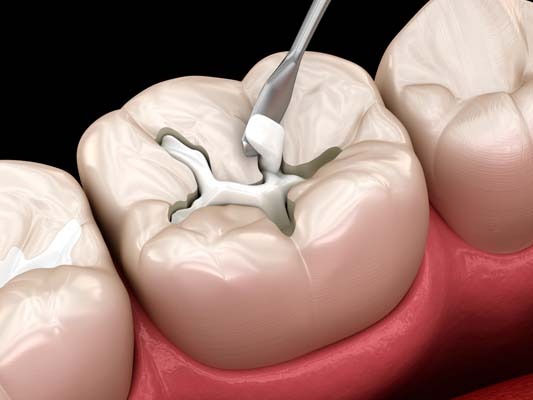 Dental Filling SmileArt Kenya