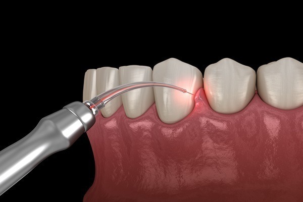Dental Gum Disease Treatment
