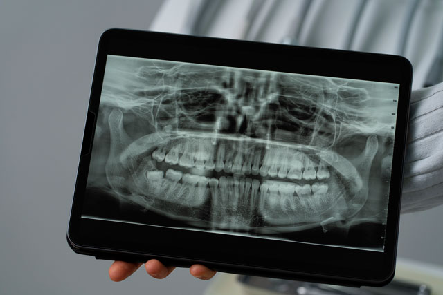 Experience Comfort: How Digital X-rays are Revolutionizing Dentistry in Kenya 5 Dental-X-ray-SmileArt-