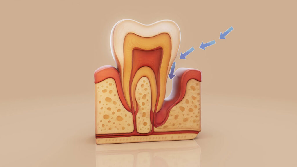 A Guide to Choosing the Right Tooth Filling Material for Your Dental Health 31 Filling-cavity-SmileArt-Kenya-