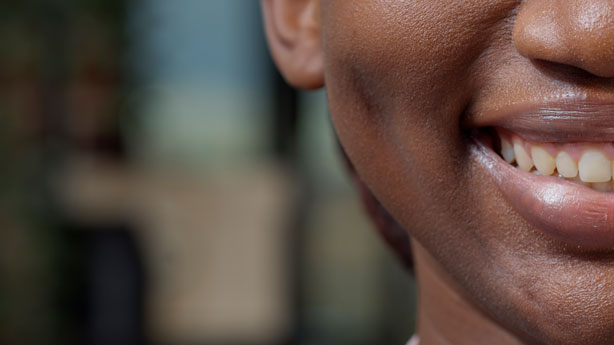 Dental Veneers: Your Complete Guide to a Perfect Smile Transformation 41 Veneers-SmileArt-Kenya-